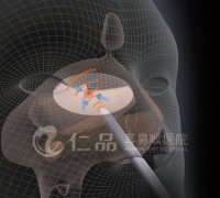 <b>��HIFU�ɲ���������ɱ��</b>