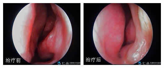 过敏性鼻炎
